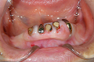 前歯部の例