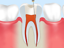 歯内療法（根管治療）の流れ<初回歯内療法の場合>