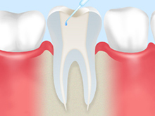 歯内療法（根管治療）の流れ<初回歯内療法の場合>
