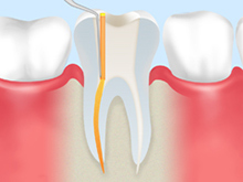 歯内療法（根管治療）の流れ<初回歯内療法の場合>