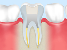 歯内療法（根管治療）の流れ<初回歯内療法の場合>