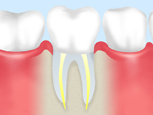 歯内療法（根管治療）の流れ<初回歯内療法の場合>