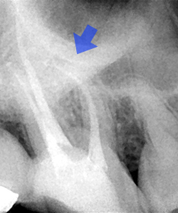 湾曲根管のケース（初回根管治療）【治療後】