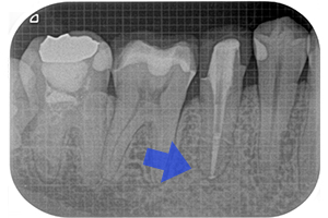 根尖病変のケース（再根管治療）【治療後】