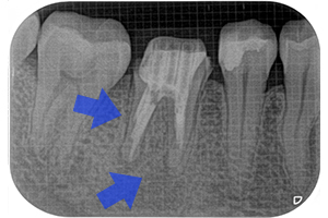 破折ファイル除去のケース（再根管治療）【治療後】