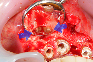 外科的歯内療法のケース（再根管治療）【外科処置中】