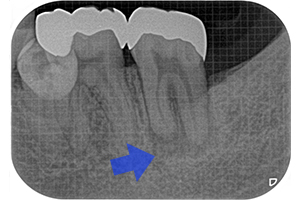 歯内－歯周病変のケース（初回根管治療）【治療前】