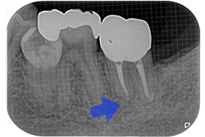 歯内－歯周病変のケース（初回根管治療）【治療後】
