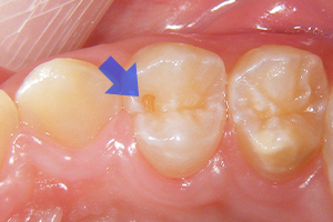 小さなむし歯のケース【治療前】