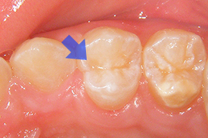 小さなむし歯のケース【治療後】