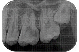 神経まで達したむし歯のケース　歯内療法（根管治療）2【治療前】