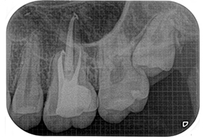 神経まで達したむし歯のケース　歯内療法（根管治療）2【治療後】
