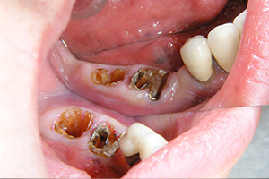 臼歯部の例