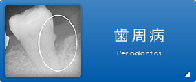 歯周病 Periodontics