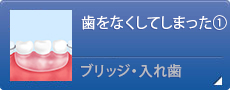 歯をなくしてしまった①ブリッジ・入れ歯