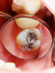 初期段階のむし歯