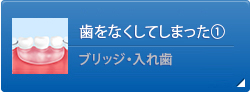 歯をなくしてしまった①ブリッジ・入れ歯