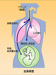 歯周病と全身疾患の関係