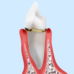 歯周病の症状と治療法