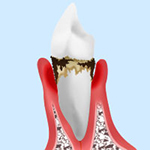 歯周病の症状と治療法