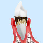 歯周病の症状と治療法