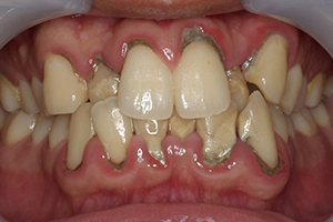 歯周基本治療のみで対処したケース【治療前】