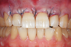 根面被覆術で対処したケース【処置直後】