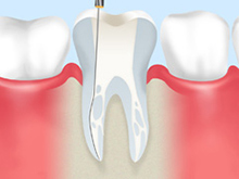 歯内療法（根管治療）